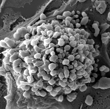 a human breast cancer cell coded with extracellular vesicles